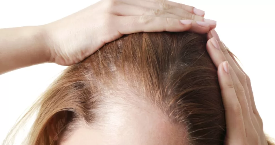 Alopecia androgenética: O que é, suas causas e como tratar
